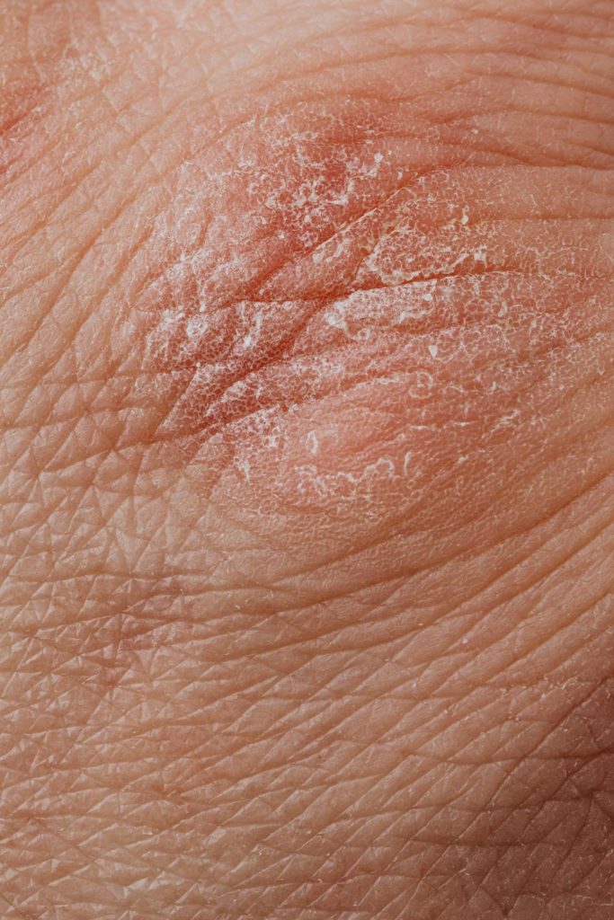 omega-3 psoriasis benefits - picture of elbow skin with psoriasis