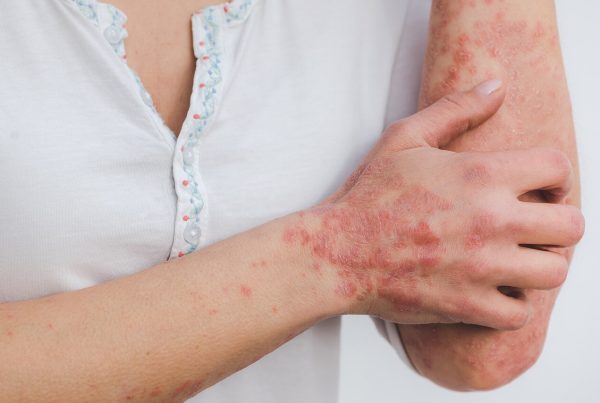 a woman with psoriasis scratching her arm - picture used in article about psoriasis treatment